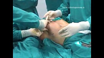 ,Breast Augmentation transaxillary, prima e dopo, mastoplastica additiva per via ascellare - YouTube